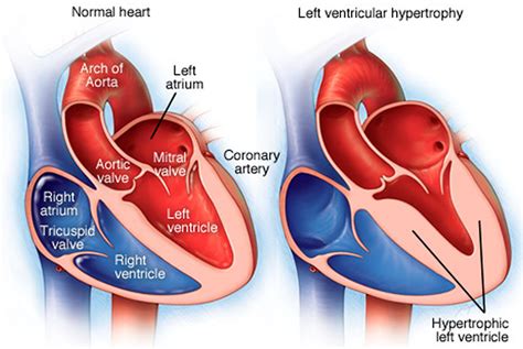 mild concentric lvh symptoms.